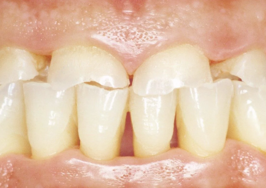 Лечение бруксизма в стоматологии